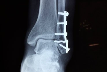 cirugia ortopedica